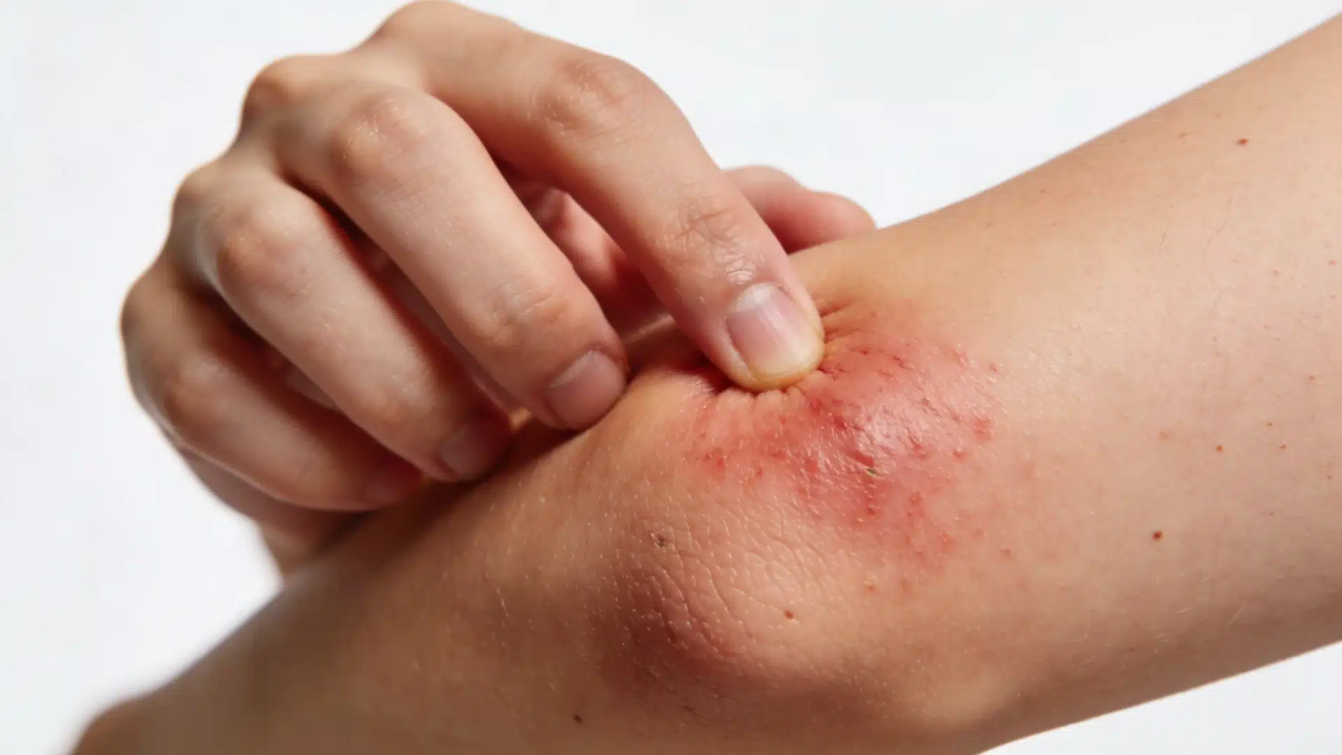 Close-up of a person using a finger to scratch or press a red, inflamed, and irritated patch of skin, likely on an elbow or joint area.