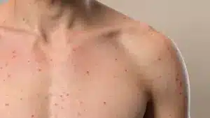 Close-up of a person's bare chest and shoulder showing numerous small, red spots indicating a skin rash or infection.