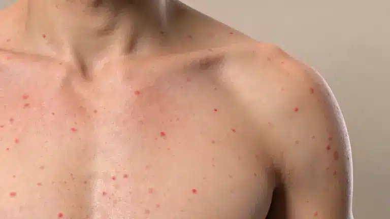 Close-up of a person's bare chest and shoulder showing numerous small, red spots indicating a skin rash or infection.