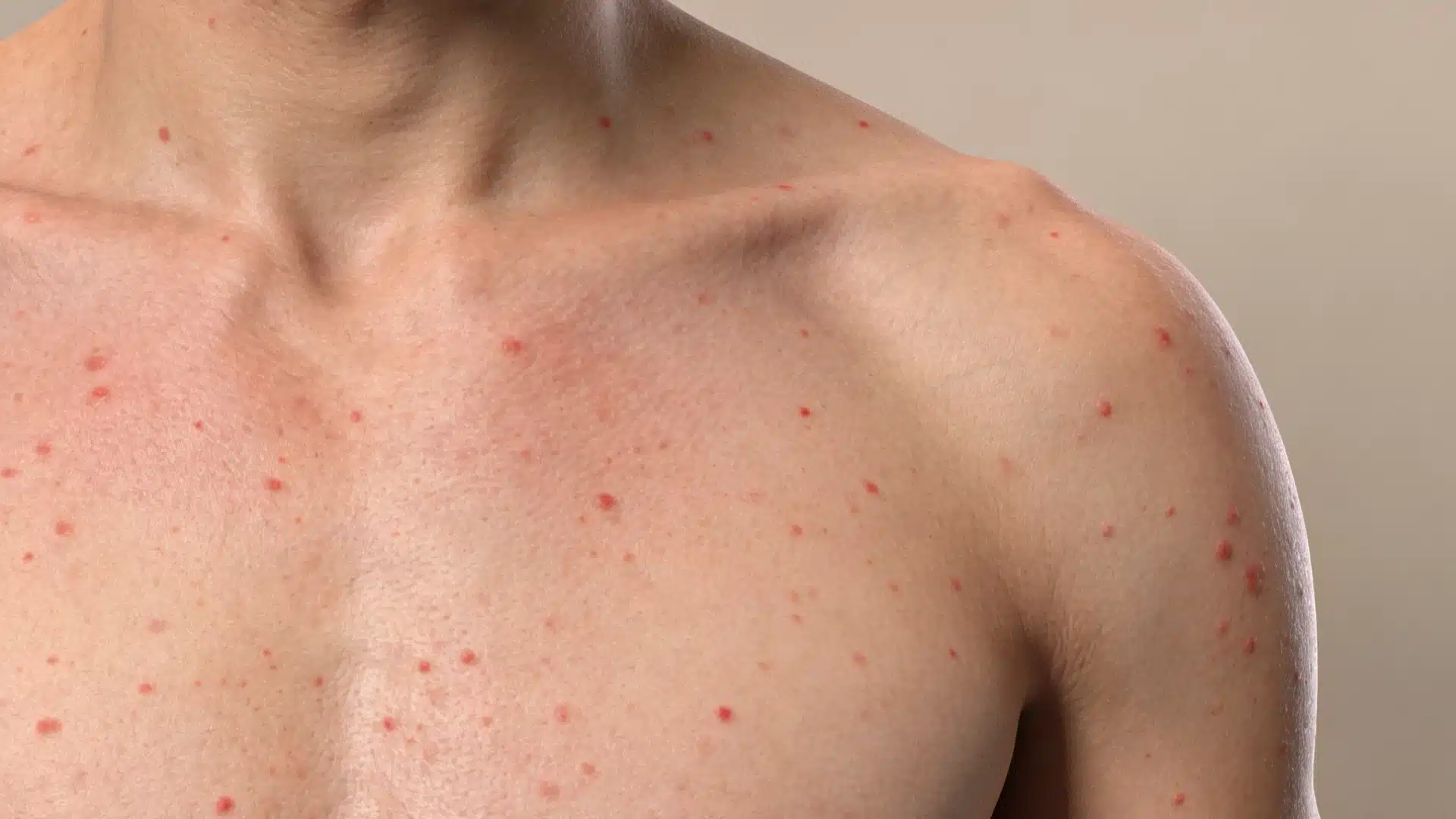 Close-up of a person's bare chest and shoulder showing numerous small, red spots indicating a skin rash or infection.